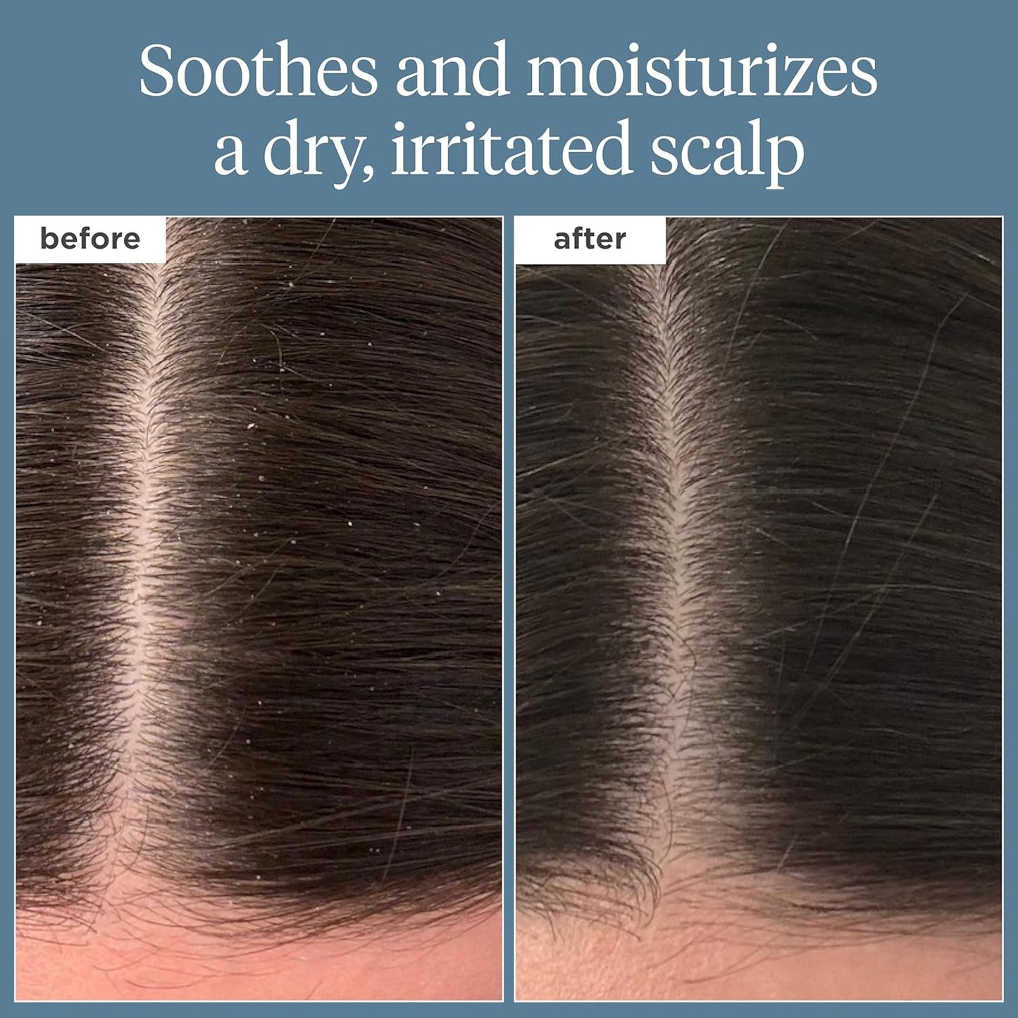 Scalp Revival Rosemary Pre-Wash Oil, Hair and Scalp, Dry Scalp Treatment for Stronger and Longer Hair, Soothe Dry Scalp, Lipids and Vitamins, Deep Moisture, Vegan, Cruelty-Free, 3.4 Fl Oz