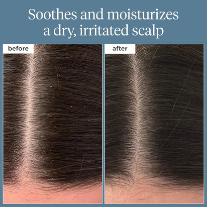 Scalp Revival Rosemary Pre-Wash Oil, Hair and Scalp, Dry Scalp Treatment for Stronger and Longer Hair, Soothe Dry Scalp, Lipids and Vitamins, Deep Moisture, Vegan, Cruelty-Free, 3.4 Fl Oz