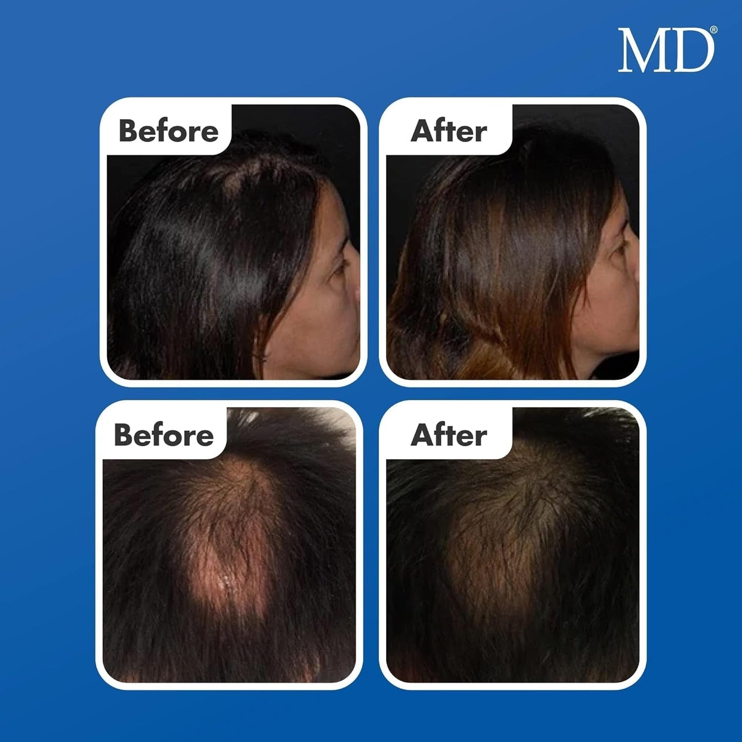 Factor Suero Natural Para El Crecimiento Del Cabello | Follicle Energizer Serum: Evita El Adelgazamiento Del Cabello Y La Pérdida De Cabello Al Estimular Los Folículos Capilares Para Producir Un Ca